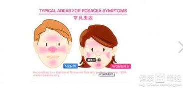 玫瑰痤疮吃哈密瓜,天然食疗的护肤之道