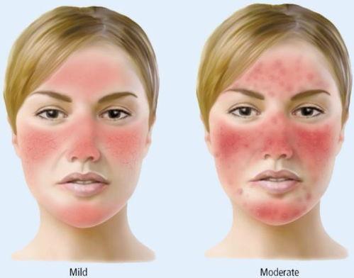 玫瑰痤疮吃哈密瓜,天然食疗的护肤之道