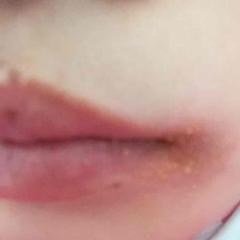 吃白瓜烂嘴角,预防烂嘴角小贴士